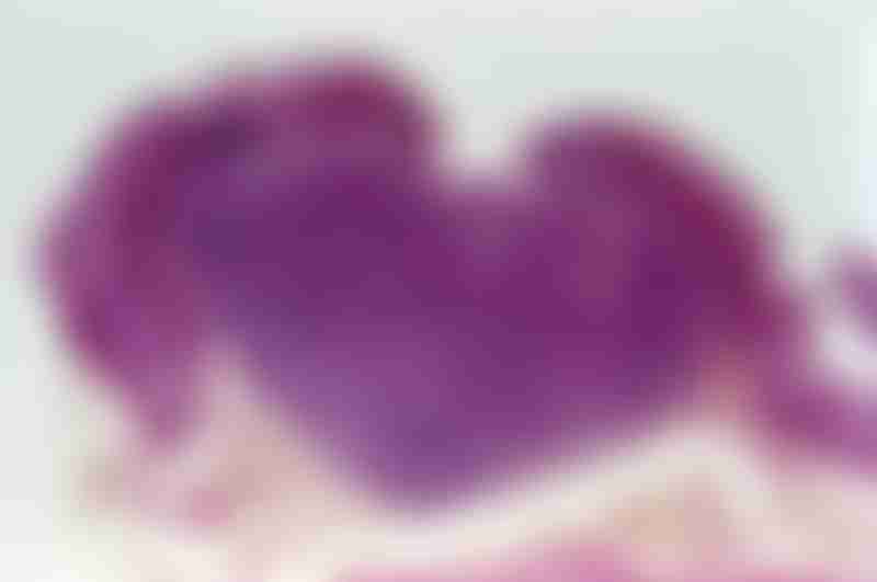 Gastric Carcinoid Light Micrograph